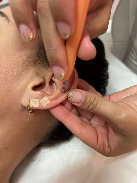 Auriculoterapia